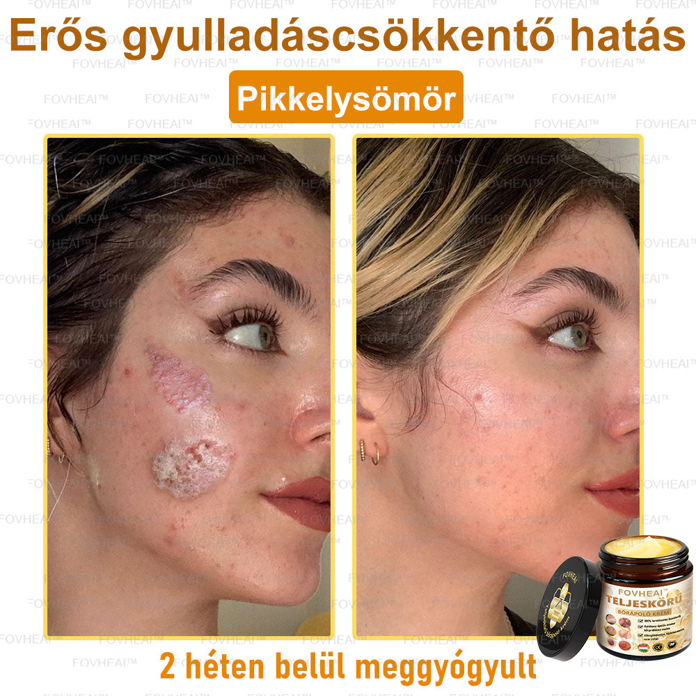 💎🏆💎FOVHEAl™ Méhméreg Teljeskörű Bőrápoló Krém - Antioxidáns, hidratáló, bőrfelújító, bőrszín-egyensúlyozó, akne és sötét foltok kezelése, szemölcs és anyajegy eltávolítása, pikkelysömör enyhítése