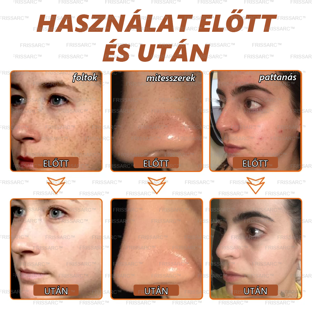 💟FRISSARC™ fehérítő és folteltávolító arcmaszk –👩‍⚕️Természetes összetevők tartósan eltüntetik a foltokat, szeplőket és napfoltokat.