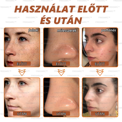 💟FRISSARC™ fehérítő és folteltávolító arcmaszk –👩‍⚕️Természetes összetevők tartósan eltüntetik a foltokat, szeplőket és napfoltokat.