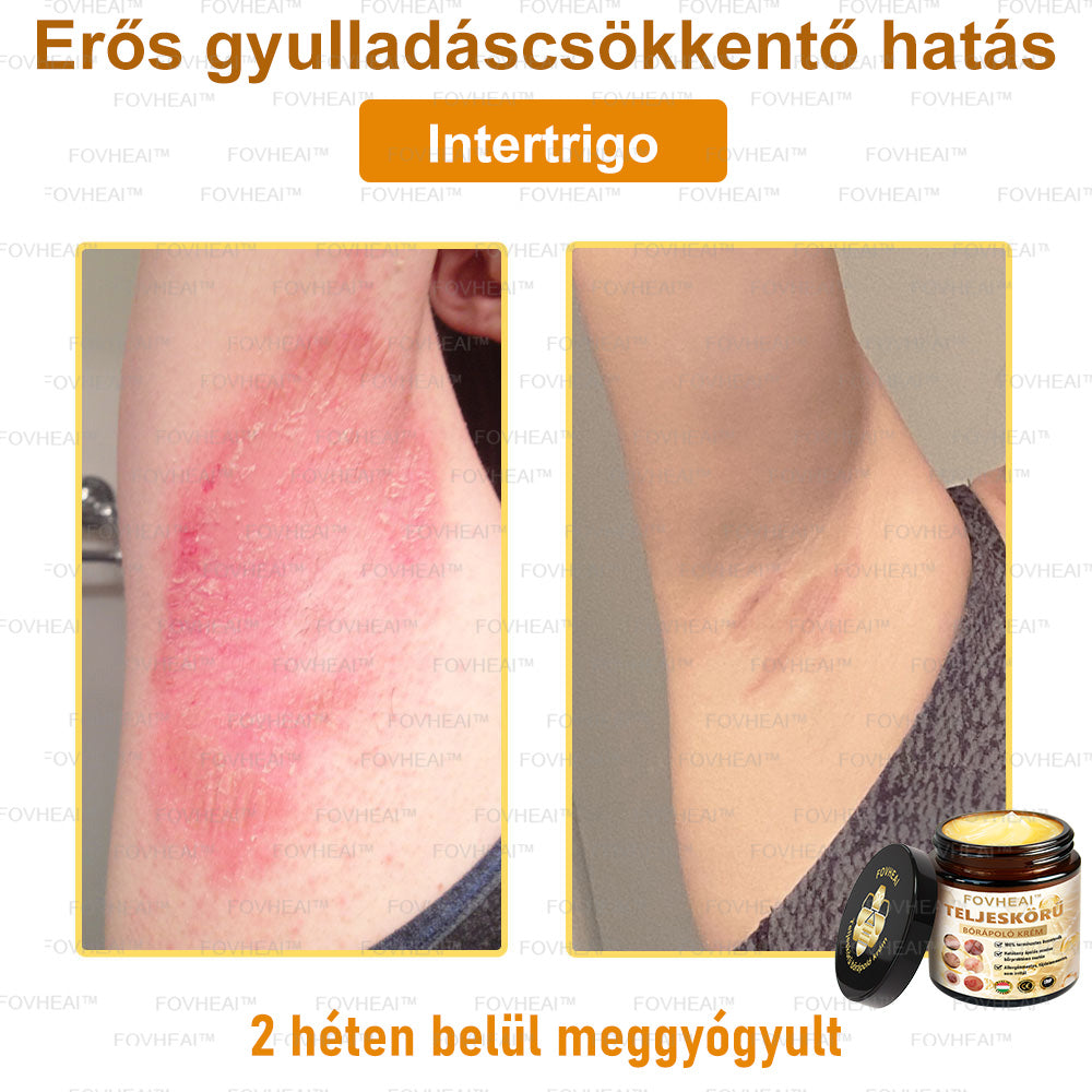 💎🏆💎FOVHEAl™ Méhméreg Teljeskörű Bőrápoló Krém - Antioxidáns, hidratáló, bőrfelújító, bőrszín-egyensúlyozó, akne és sötét foltok kezelése, szemölcs és anyajegy eltávolítása, pikkelysömör enyhítése