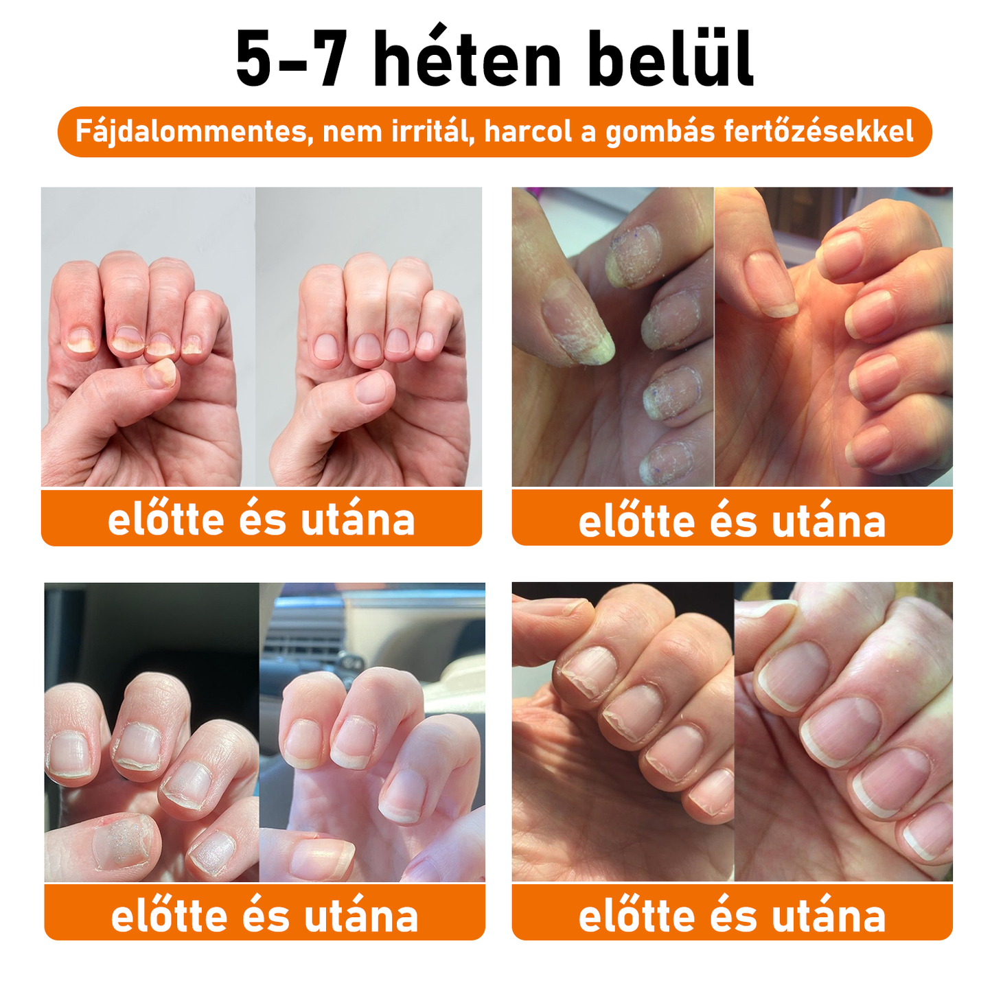 💝[✨𝐇𝐢𝐯𝐚𝐭𝐚𝐥𝐨𝐬 𝐌á𝐫𝐤𝐚𝐛𝐨𝐥𝐭✨]KörömVital™ Méhméreg Baktériumölő Körömkezelő Szérum