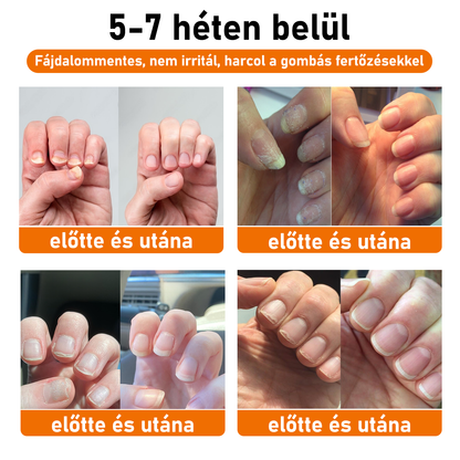 💝[✨𝐇𝐢𝐯𝐚𝐭𝐚𝐥𝐨𝐬 𝐌á𝐫𝐤𝐚𝐛𝐨𝐥𝐭✨]KörömVital™ Méhméreg Baktériumölő Körömkezelő Szérum