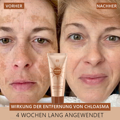 💟FRISSARC™ fehérítő és folteltávolító arcmaszk –👩‍⚕️Természetes összetevők tartósan eltüntetik a foltokat, szeplőket és napfoltokat.