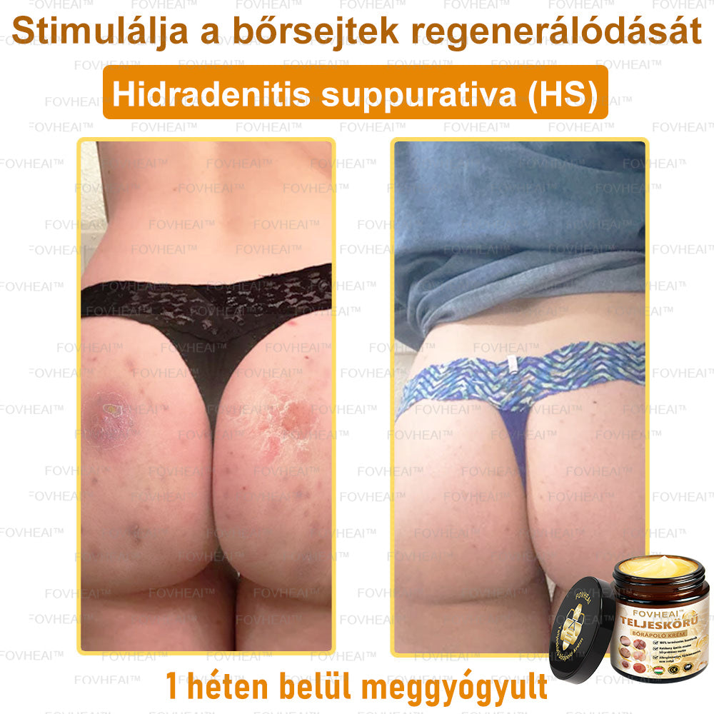💎🏆💎FOVHEAl™ Méhméreg Teljeskörű Bőrápoló Krém - Antioxidáns, hidratáló, bőrfelújító, bőrszín-egyensúlyozó, akne és sötét foltok kezelése, szemölcs és anyajegy eltávolítása, pikkelysömör enyhítése