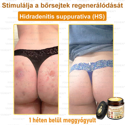 💎🏆💎FOVHEAl™ Méhméreg Teljeskörű Bőrápoló Krém - Antioxidáns, hidratáló, bőrfelújító, bőrszín-egyensúlyozó, akne és sötét foltok kezelése, szemölcs és anyajegy eltávolítása, pikkelysömör enyhítése