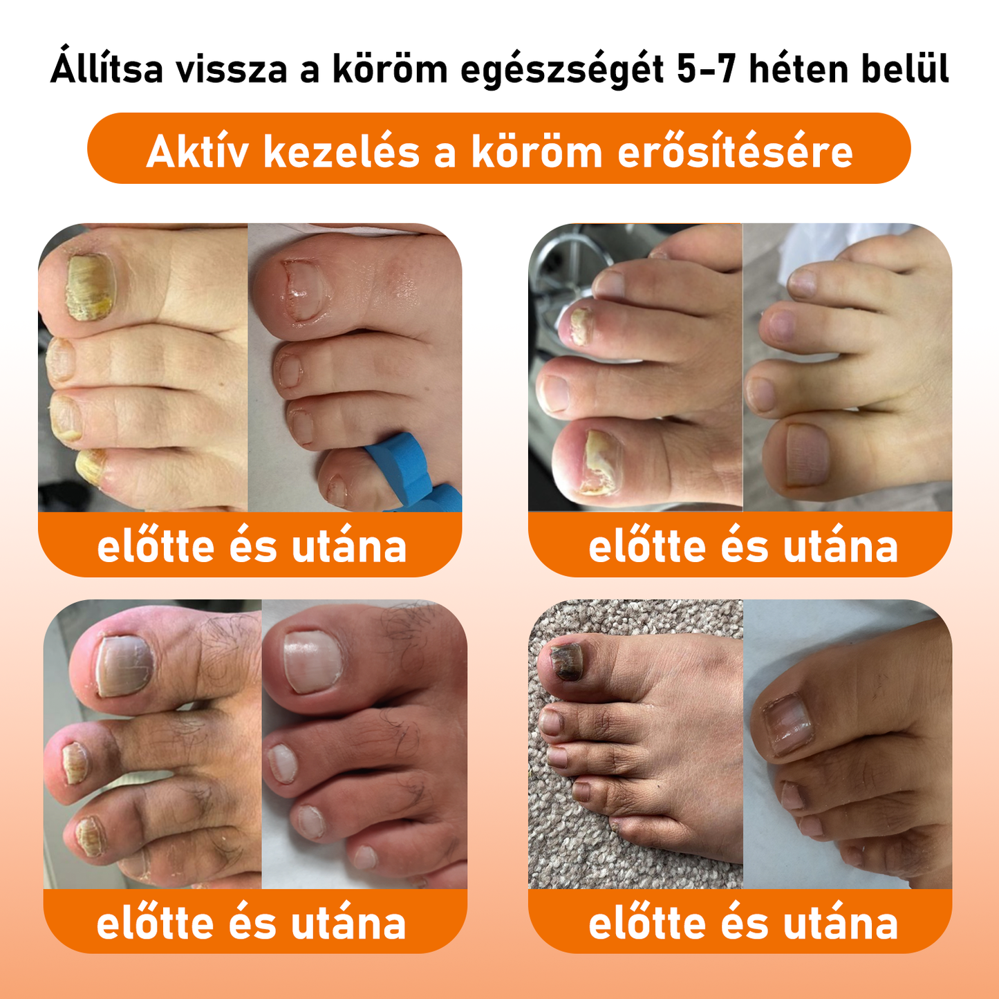 💝[✨𝐇𝐢𝐯𝐚𝐭𝐚𝐥𝐨𝐬 𝐌á𝐫𝐤𝐚𝐛𝐨𝐥𝐭✨]KörömVital™ Méhméreg Baktériumölő Körömkezelő Szérum