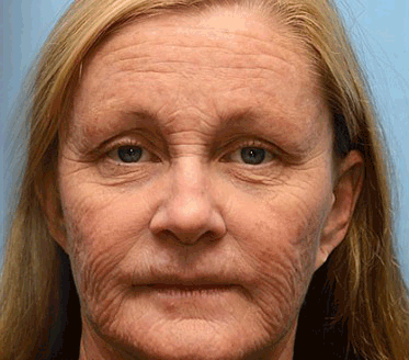 💛FrissArc™ Botox Méhméreg Ránctalanító Krém